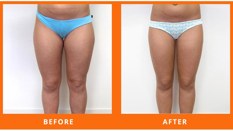 3D Lipo Laser